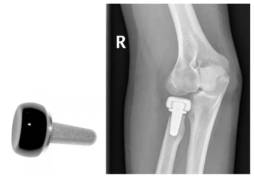 Radial Head Replacement