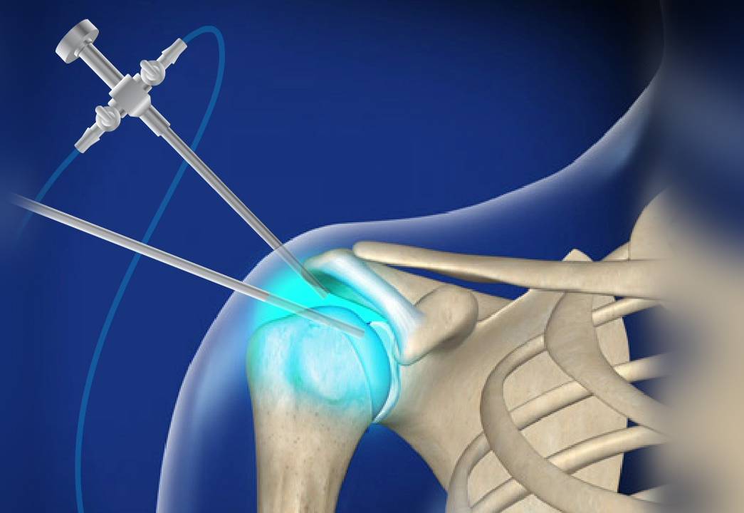 Shoulder Arthroscopy