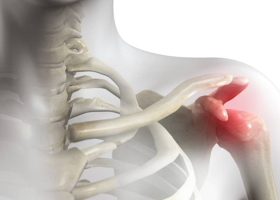 Shoulder Impingement