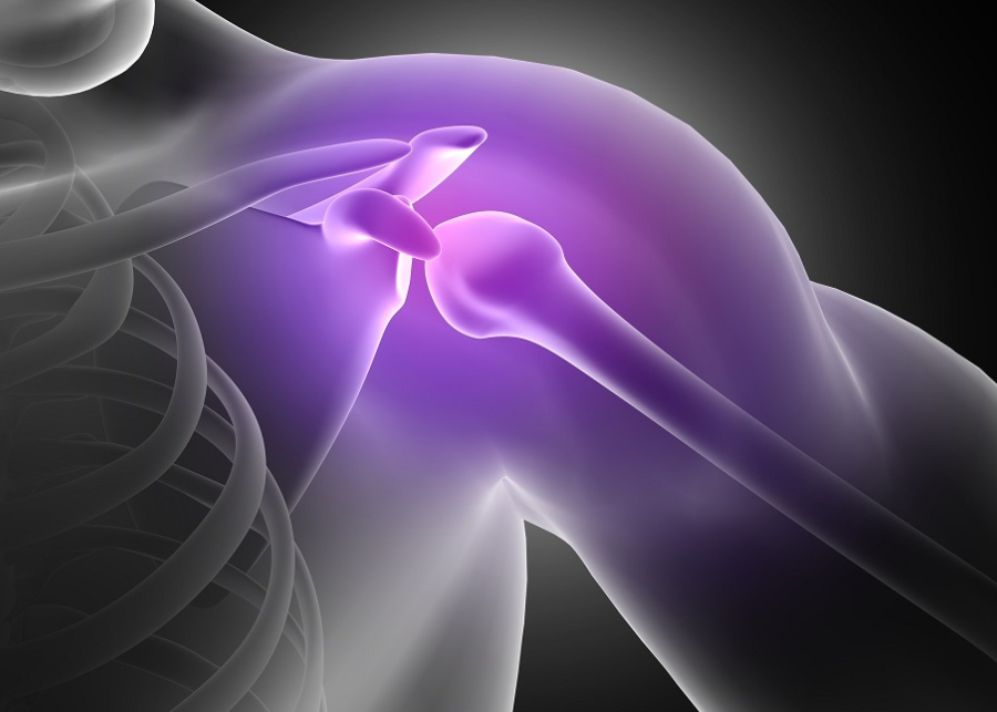 Shoulder Joint Replacement