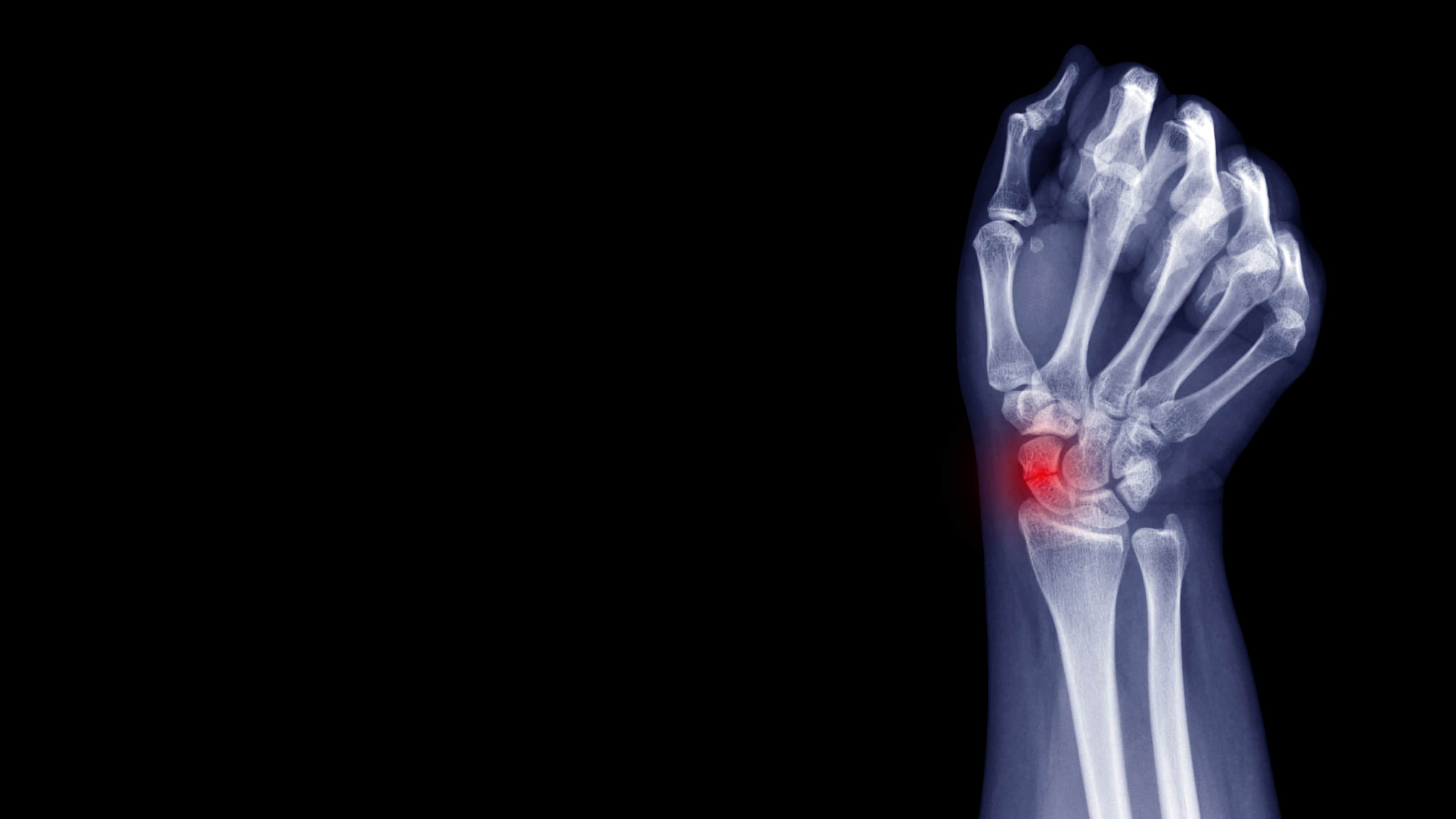 Wrist Scaphoid Fractures