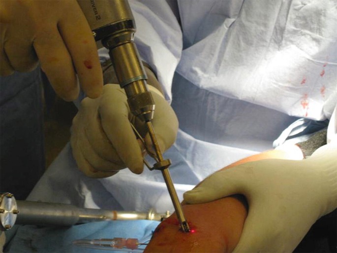 Wrist Scaphoid Nonunion